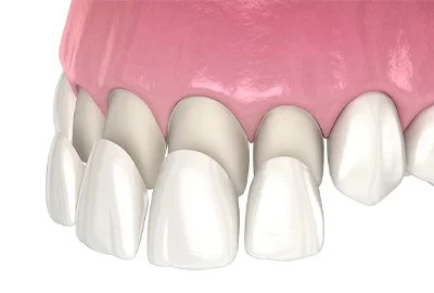 Hollywood Smile transformation at Perfect Smile Turkey, featuring E-max or Zirconia veneers for a radiant smile in Antalya.