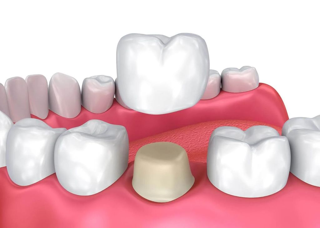 Zirconia crowns for superior strength and durability in dental treatments by Perfect Smile Turkey, an Antalya dental clinic.