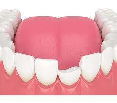 3D mockup of a chipped tooth, illustrating potential dental repair with composite bonding or dental crowns at Perfect Smile Turkey in Antalya.
