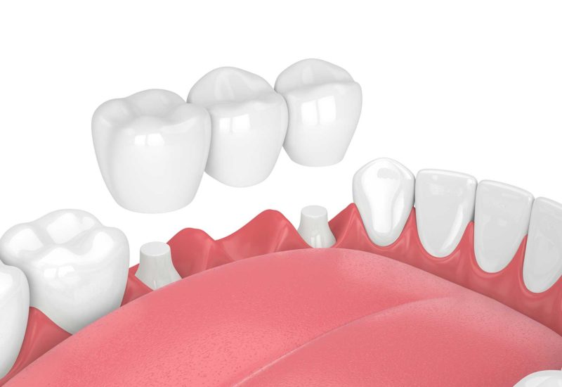 Dental bridge 3D mockup illustrating tooth replacement for a missing tooth, a service offered by Perfect Smile Turkey in Antalya.