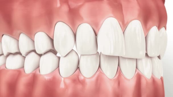 Patient smiling with brilliant Emax veneers, highlighting successful cosmetic dentistry by Perfect Smile Turkey. Experience premium dental treatment at our Antalya dental clinic.