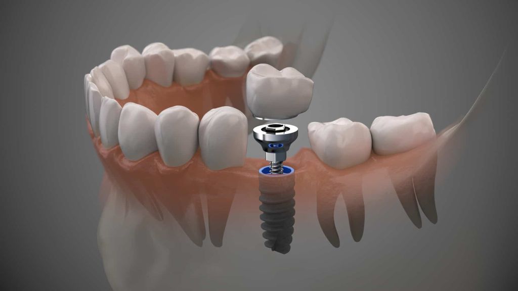 full mouth dental implant