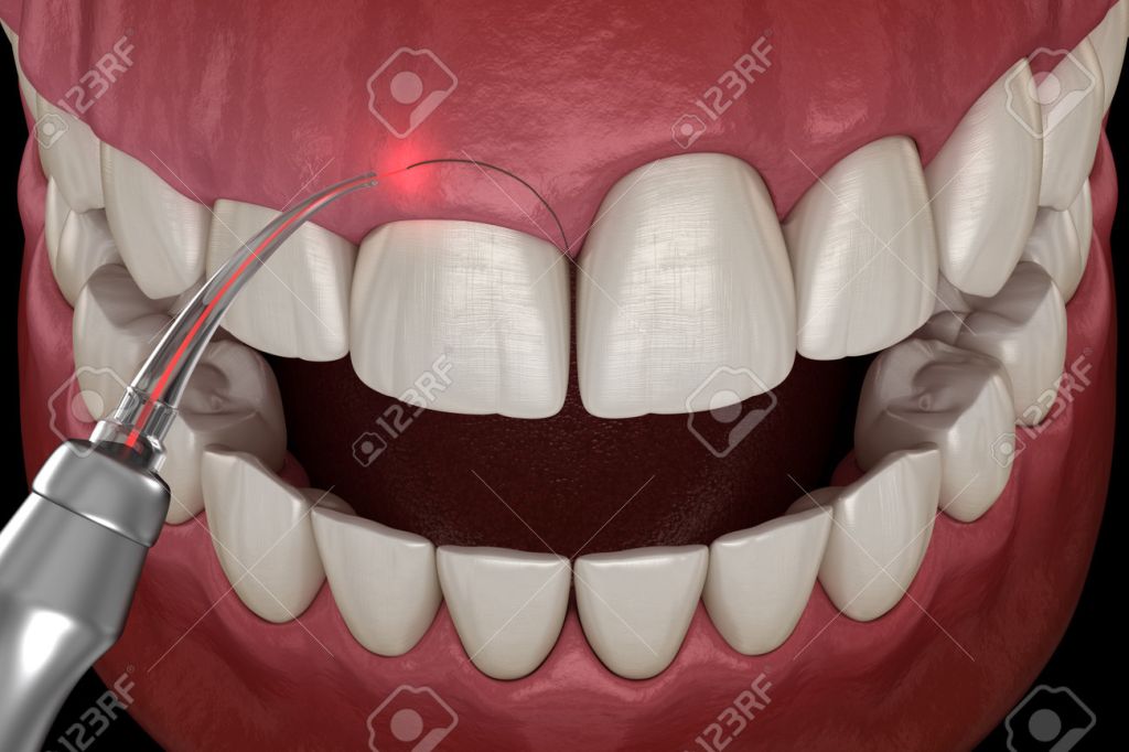 Gingivectomy 3D mockup illustrating gum contouring for aesthetic smile design at Perfect Smile Turkey, a leading Antalya dental clinic.