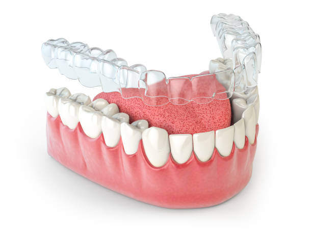 3D illustration of an Invisalign invisible aligner on a lower jaw, representing discreet orthodontic treatment at Perfect Smile Turkey, an Antalya dental clinic.