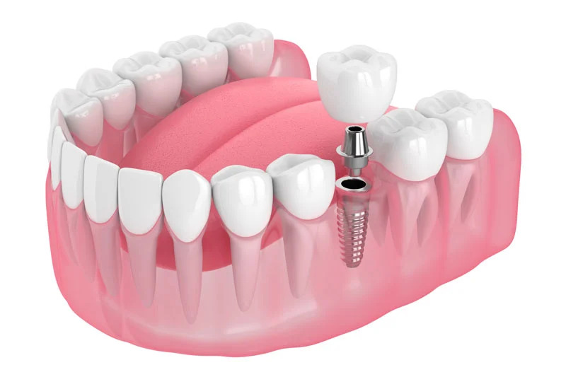 3D single tooth dental implant illustration by Perfect Smile Turkey, expert dental clinic in Antalya for missing tooth replacement.