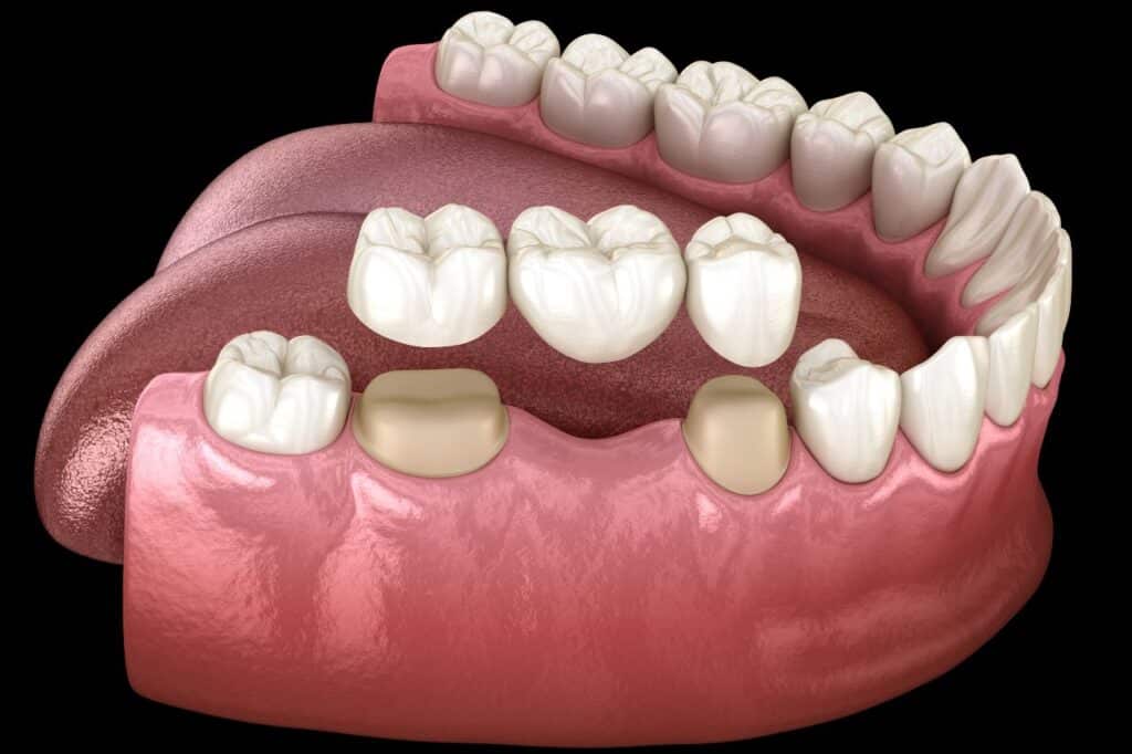 3D dental bridge model for single tooth replacement at Perfect Smile Turkey, an Antalya dental clinic.