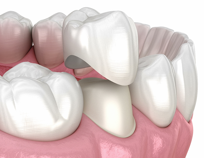 3D rendering of a premium zirconia crown, representing high-quality dental restorations available at Perfect Smile Turkey in Antalya.