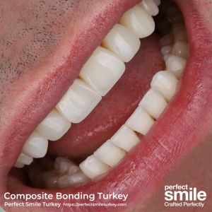 Edge bonding composite restoration for chipped front teeth repairing fractures without drilling at Perfect Smile Turkey in Antalya.