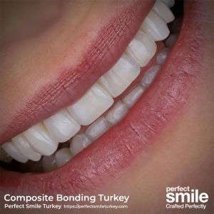 Minimally invasive nano-hybrid composite resin veneers application for a smile makeover at Perfect Smile Turkey, a leading dental clinic in Antalya, Turkey. Ideal for composite bonding and aesthetic dentistry in Turkey.