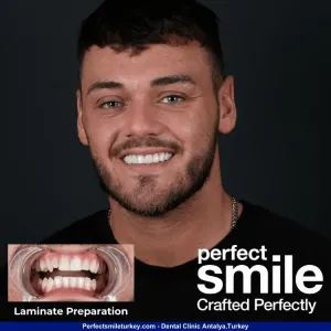 Ryan Jones' E-Max Veneers before and after results from Perfect Smile Turkey in Antalya, showcasing a stunning smile transformation achieved at our dental clinic in Turkey.