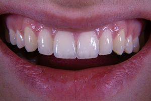 Full mouth dental implant denture with zirconia crowns after successful treatment at Perfect Smile Turkey, a leading Antalya dental clinic specializing in Turkey dental implants.