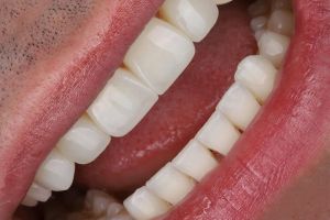 Edge bonding composite restoration for chipped front teeth repairing fractures without drilling at Perfect Smile Turkey in Antalya.