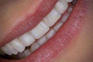 Minimally invasive nano-hybrid composite resin veneers application for a smile makeover at Perfect Smile Turkey, a leading dental clinic in Antalya, Turkey. Ideal for composite bonding and aesthetic dentistry in Turkey.